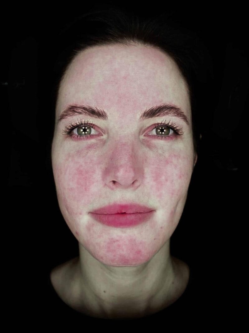 320-redness-scaled