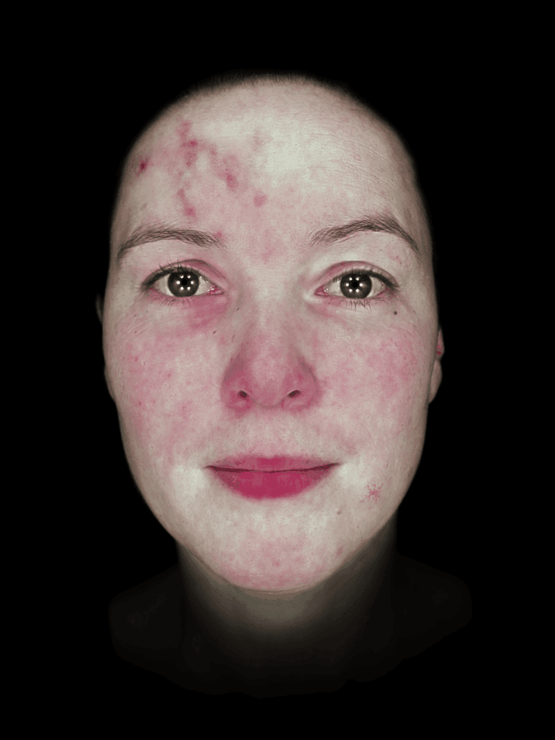 observ_qrc_520x_2020-model_redness
